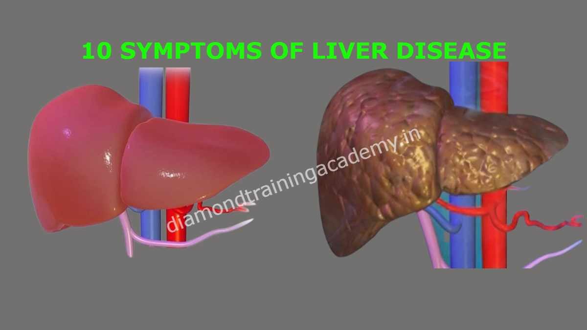 10 SYMPTOMS OF LIVER DISEASE